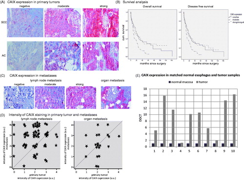 Figure 1. Esophageal carcinoma tissue and microarray. (A) Tissue micro array (TMA) of esophageal carcinoma primary tumour and metastatic tissue was examined for CAIX expression and grouped into negative, moderate, and strong CAIX expression. Figure 1(A) shows representative samples of immunohistochemical CAIX staining for adenocarcinoma and squamous cell carcinoma at a standard magnification of ×20. (B) Patients with a moderate CAIX expression had a significantly worse overall (p = .003 and p = .009) and disease free (p = .006 and p = .015) survival compared to patients with no or a strong CAIX expression. (C,D) CAIX expression of primary tumour was correlated with CAIX expression of lymph node and organ metastases (representative immunohistochemical stainings are shown in Figure 1(C). Figure 1(D) shows the correlation of the intensity of CAIX staining (0-none, 1-low, 2-moderate, 3-strong, 4-strongest) of primary tumour and metastases. The left graph depicts the intensity of CAIX staining of the lymph node metastases, the right graph shows the intensities of the organ metastases in correlation to the intensity score of their primary tumour. Interestingly, most lymph node metastases occurred in the group with a moderate CAIX expression and thus impaired prognosis (group 2 in Figure 1(D)) and the metastatic lymph nodes of these patients overall expressed CAIX in higher intensities than any of the others. (E) All tumour samples (n = 10), although to a different extent, showed an increased expression of RNA levels in quantitative PCR compared to their respective normal mucosal control tissues.