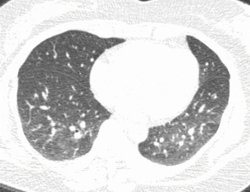 Figure 2.  Axial CT image in a non-smoking, physiologically normal subject, where reviewers scored visual gas trapping, but quantitative% of gas trapping was only 11%. CT shows relatively mild multilobular gas trapping, which did not reach the quantitative threshold for gas trapping.