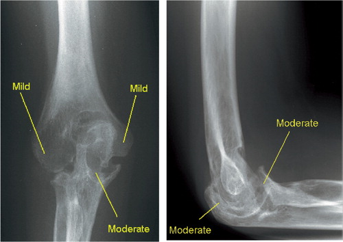 Figure 3. The amount of bone resorption in the epicondyles, the olecranon and the coronoid process. coronoideus. The resorption is classified as none, minimal, moderate or severe.