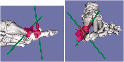Figure 4. The simulation for setting the metatarsal and proximal phalanx cutting templates (red). The K-wires (green) are perpendicular to the longitudinal axis of the metatarsal and proximal phalanx. The projections given were programmed to guide the bone saw in cutting the metatarsal and phalanx perpendicular to the longitudinal axis (*).