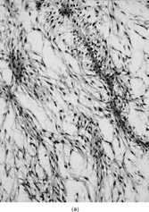 FIG. 1 Microscopic appearance of low-grade myxofibrosarcoma: (A) low power with spindle cells separated by abundant myxoid stroma and showing condensation around curvilinear vessels (×200;MFS6); (B) detail of a pseudo-lipoblast showing multivacuolated cytoplasm, with similar appearance as the extracellular matrix (×400;MFS15).