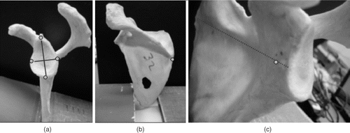 Figure 3. Selection of anatomical landmarks on the scapula: (a) superior, inferior, anterior, and posterior points; (b) medial point; (c) transverse axis.