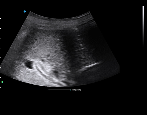 Figure 2 Subcostal axial view showing hyperechoic structures in the common bile duct.