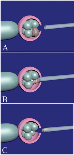 Figure 3. Lysed blastomere removal in a cleavage-stage embryo. Firstly, the embryo is held by the holding pipette. The place of zona pellucida opening should be near the lysed blastomere(s). A hole about 20 µm in diameter is created with a noncontact 1.48 diode laser. After opening of the zona pellucida (A), an appropriate micropipette is inserted near the lysed blastomere (B). The lysed blastomere is gently removed (C) using a × 25 objective. If there is another lysed blastomere, the previous step is repeated. Finally, the embryo is released from the holding pipette.
