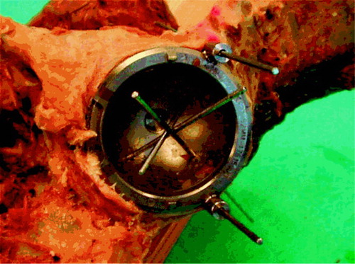 Figure 1b. Photo of specimen showing drill-guide Kirschner wire placement.