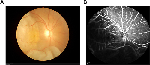 Figure 3 Fundus camera image of HCC patients. (A) Retinal fundus photography. (B) Fundus fluorescence angiography.