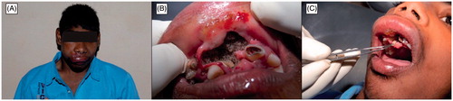 Figure 2. Oral myiasis by Chrysomya bezziana. (A) Appearance of the patient before maxillary surgery, (B) maggots in the maxillary anterior region, and (C) removal of maggots with tweezers. Figure adopted with publisher’s permission from Ref. Citation56.