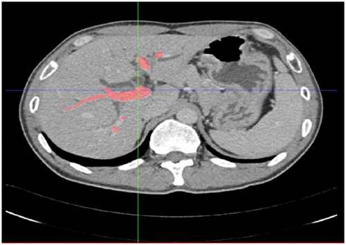 Figure 1. The segmented 2D plane based on CT images. The red area indicates segmented hepatic blood vessel.