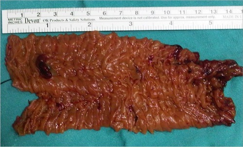 Figure 2 Resection material from the jejunum that includes a Dieulafoy’s lesion.