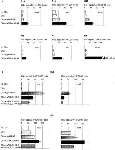 Figure 1. CD8+ T-cell responses after in vitro stimulation with in vitro transcribed -RNA encoding NPM-ALK in ALCL-patients.Purified T-cells (either CD8+ or CD3+) from ALCL-patients in remission were stimulated with irradiated autologous DCs transfected with NPM-ALK IVT-RNA. After two weekly re-stimulations, day 19 responder T-cells were tested in an IFN-γ ELISPOT assay for recognition of autologous DCs untransfected or transfected with IVT-RNA encoding NPM-ALK or – as a control – HCMV pp65 (3-6 × 103/well). Data are shown for representative microculture (mc) responder populations of patients R2, R4, R8, R10, R13, R15, in whom CD8+ blood-derived T-cells had been stimulated (a), and of patients R20 and R21, in whom stimulations had been performed on CD3+ blood T cells. The NPM-ALK-responder populations were partially inhibited with the pan HLA-class I-specific antibody W6/32 (b). Bars represent the means of duplicates ± standard deviation.