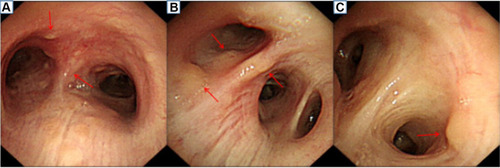 Figure 4 Bronchoscopic examinations. (A–C) The trachea and the walls of the left and right main bronchi are scattered with small nodules. The nodules are partially fused near the carina (the red arrow indicates the lesion site).