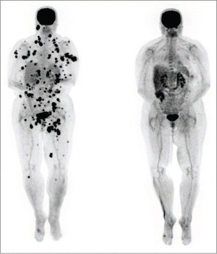 Figure 1. Patient 1. PET/CT in 12/12 (left, prior to vemurafenib) showed innumerable intensely FDG avid lymph nodes and soft tissue deposits scattered throughout the body which developed during her course of ipilimumab by 2 cycles. PET/CT in 2/13 (right, after starting vemurafenib and completion of the ipilimumab course) showed the previously described intensely FDG avid metastases had entirely resolved. The vemurafenib was weaned and completely stopped by 12/13. She has remained in complete remission to date off all therapy.