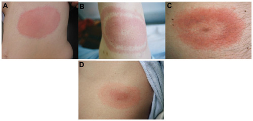 Figure 1 Typical expanding skin lesions.