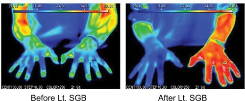Figure 1 Thermography showing elevation in skin temperature in the upper limb by over 1ºC following SGB