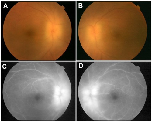 Figure 3 Fundus photographs and fluorescein angiograms for case 2 with sarcoidosis. (A and B) Fundus photographs taken at the initial examination. Numerous snowball-like vitreous opacities and optic neuritis can be seen in both eyes. (C and D) Fluorescein angiograms showing dye leakage from the optic discs and along the retinal veins in both eyes. (A and C) right eye, (B and D) left eye. vitrectomy on both eyes. Vitreous samples were obtained as in case 1. Epithelioid and multinucleated giant cells were found by vitreous cytology (Figure 4). Necrotic materials and malignant cells were not detected. Because of his poor condition, he received a posterior sub-Tenon injection of triamcinolone acetonide in both eyes instead of systemic corticosteroid therapy. One month after pars plana vitrectomy, the optic neuritis was resolved and corrected vision had improved to 20/20 OD.