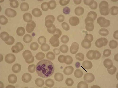 Figure 2. Blood film of Patient 1 showing macrothrombocytopathy (arrow).