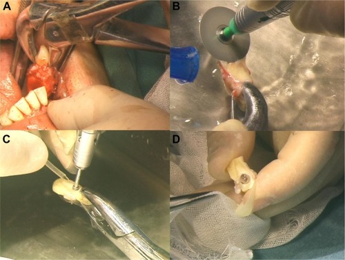 Figure 7 OOKP stage 1 – tooth extraction and preparation of the OOAL lamina.