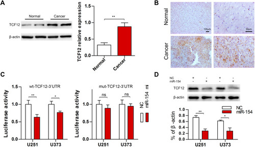 Figure 5 TCF12 was highly expressed in GBM tissues and could be regulated by miR-154. (A) Western blot analysis showed increased expression of TCF12 in mut-p53 GBM tissues compared with adjacent normal tissues. (B) TCF12-positive cells were increased and highly expressed in both the nucleus and cytoplasm of mut-p53 GBM tissues. (C) The luciferase reporter activity was decreased when cells were cotransfected with miR-154 mi and wt-TCF12 3’-UTR. (D) TCF12 protein levels were detected in U251 and U373 cells after transduction with miR-154 lentivirus (*p<0.05, **p<0.01, ns: no significance).