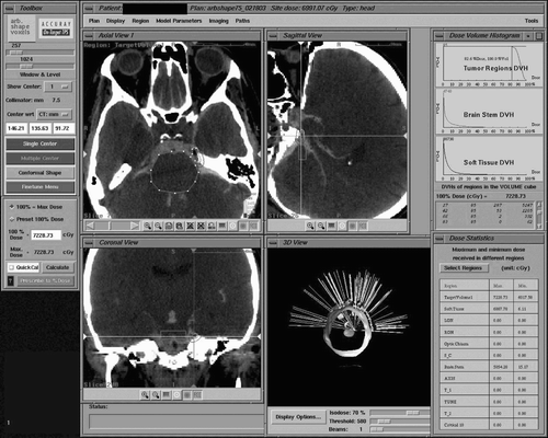 Figure 2. Example of a treatment plan where the Gasserian ganglion was inadvertently included in the target volume. [Color version available online]