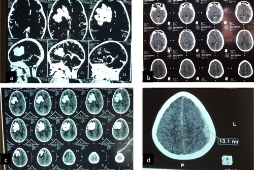 Figure 1. Cerebral hematoma. (a and c) subacute hemorrhagic stroke with falcorial engagement in an 11-month-old infant; (b) left hemispherical multiple acute extradural hematoma associated with hyperdensities of the subarachnoid spaces; (d) left hemispheric acute subdural hematoma.