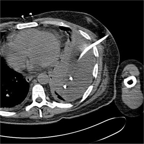 Fig. 3 Small bore chest tube was placed from an anterior approach.