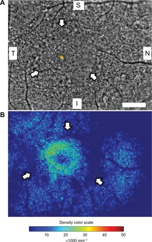 Figure 2 Panoramic adaptive optics fundus image (A) and cone density map (B) of the right eye in case 1. (A) Panoramic adaptive optics fundus image 2.42 × 3.16 mm in area including the fovea (yellow asterisk). Arrows show a blurred ring area of cone mosaics which corresponds to the parafoveal high-density fundus autofluorescence ring. Bar = 200 μm (A). (B) Panoramic cone density map of the same area as in (A).