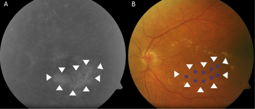 Figure 1 Example of fluorescein angiography guidance of macular laser photocoagulation (A) showing the leaking area of the macula (surrounded by arrowheads). The equivalent color fundus photograph (B) is used to show the laser spot location mapping (blue asterisks).