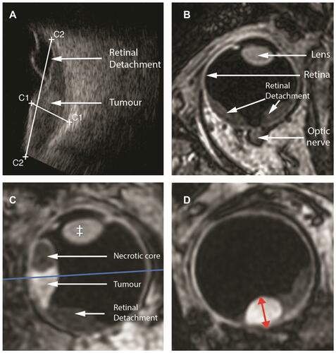 Figure 2 Conventional ultrasound imaging (A) only provides a 2-dimensional cross-section of the tumour, whereas MR (magnetic resonance) imaging (B, C, D) enables a complete 3-dimensional evaluation of the tumour and surrounding structures. Although the original MRI scan (B) is acquired in a transverse direction, the isotropic spatial resolution allows for reformatting in every direction (C, D). To accurately determine the tumour thickness, a reformatting is made which goes through the thickest location of the tumour and is angulated perpendicular to the tumour (blue line in C). On the resulting reformatted scan (D) the tumour thickness can be accurately measured (red arrow).