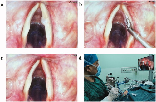 Figure 2. Laryngeal exposure and a precise bimanual monitor-guided operation with curved video SL. The entire glottis was exposed including the anterior commissure. Preoperative image (a). Interoperative image (b). Postoperative image (c). Bimanual operation (d).