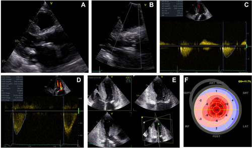 Figure 5 Transthoracic echocardiography at 1 month after after TAVR. 2D TTE, parasternal long-axis view in diastole (A) and a zoomed image with color Doppler at the level of the aortic valve (B) showing a normal looking biological prosthesis (Eduards Sapien) with no significant paraprosthetic leak. 2D TTE, apical 5 chambers view with spectral Doppler evaluation of transvalvular flow by continuous-wave Doppler (C) and left ventricle outflow tract flow by pulsed-wave Doppler (D) revealing a normal function of the prosthesis (AV peak velocity 1.75 m/s, AV peak and mean pressure gradients 12 and 7 mmHg, respectively, AV velocity time integral 29.5 cm, left ventricle outflow tract velocity time integral 17 cm, AV effective orifice area 2 cm2). 2D TTE, apical triplane imaging of the LV in diastole (E) illustrating the apical 4 chambers, 2 chambers and 3 chambers views and automated function imaging derived from the 2D speckle tracking echocardiography (F) revealing a slight amelioration of the LV longitudinal systolic dysfunction which is still severely impaired (GLS= −11.7%) with the same particular apical sparing pattern of the bull’s eye view.