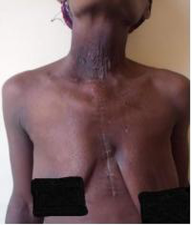 Figure 6 Post op picture of the patient taken at follow-up clinic.