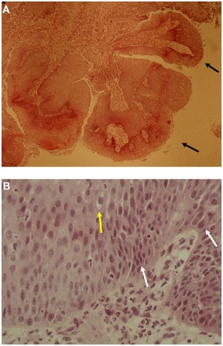 Figure 5 (A) Squamous papilloma of patient 2. The papillary growth pattern (arrows) is apparent (hematoxylin and eosin staining, ×40) and (B) Koilocytosis (yellow arrow) and mild dysplasia (white arrows) are apparent in the squamous papilloma of patient 2 (hematoxylin and eosin staining, ×400).