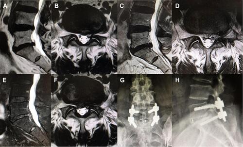 Figure 2 A 52-year-old female diagnosed with recurrent LDH 17 months after primary PELD and underwent revision MIS-TLIF. The patient presented with pain of his low back and left lower extremity that failed to be relieved with conservative therapy. Physical examinations showed 50° positive left straight leg raise test, and MRI demonstrated recurrent disc herniation on L5-S1. She received primary L5/S1 PELD surgery and had prominent pain relief postoperatively. Postoperative MRI at 12 months post primary PELD showed decompressed spinal canal and foraminal area. However, 14 months after the primary operation, the patient started to feel pain of her lower back and right lower extremity. The symptoms aggravated and she detected weakness of her right foot during walking over the next three months, but the effect of conservative treatment including oral analgesics and physical therapy proved to be poor. Physical examinations on admission showed 3/5 strength in her right peroneus muscle. Right straight leg raise test was 40° positive, while the contralateral test was 60° positive. MRI demonstrated recurrent disc herniation on L5-S1. The patient received the revision L5/S1 MIS-TLIF surgery, and she had prominent pain relief and functional recovery postoperatively.