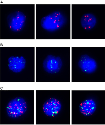 Figure 1 Representative images of the detection of CTCs in the peripheral blood of patients with colorectal cancer. (A) EpCAM expression (red fluorescence) in epithelial CTCs; (B) vimentin expression (green fluorescence) in mesenchymal CTCs; (C) EpCAM/vimentin expression (red and green fluorescence) in epithelial-mesenchymal CTCs.