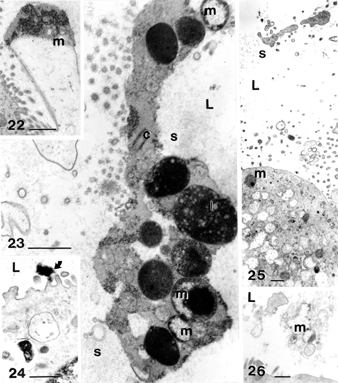 Figures 21 Biliary sludge components from cholecystocyte extrusions (curved arrows) and secretions. Remants of cells found in sludge are cell debris (A, B) wherein mitochondria (mt) membrane and endoplasmic remnants, mucus and intact mucous vesicles (in D), as well as needle-like formation (E) can be identified. L, lumen; m, mucus; ms, mucous sludge; mt, mitochondrium; s, biliary sludge. Scale bars equal 1 μm in A, B, D, and E and 200 nm in c.