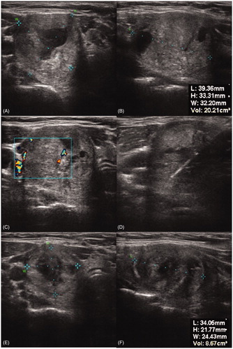 Figure 5. Ultrasound images of a thyroid nodule with central blood perfusion and surrounding cervical vessels (c), before MWA (a and b), during ablation (d) and three months after ablation (e + f).