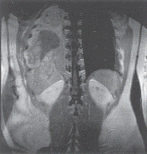 Figure 1. Massive recurrence of adult pneumoblastoma (RMI, T1-sequence with gadolinium).