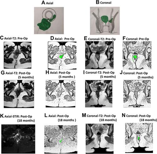Figure 4 A 31-year-old female patient with a right-sided high transsphincteric recurrent fistulas and abscess. MRI done 20 weeks after surgery showed complete healing. She had a weighted score of three as per the new scoring system (NSS). The patient had a recurrence of fistula after 18 months. (A) Axial section (schematic diagram); (B) Coronal section (schematic diagram); (C) Pre-operative axial T2-weighted MRI showing right-sided abscess; (D) Sketch of figure-(C) highlighting right-sided abscess (green color); (E) Pre-operative coronal T-2 weighted MRI; (F) Sketch of figure-(E) highlighting abscess on right side (green color); (G) Post-operative axial T2-weighted MRI showing healed fistula at 5 months; (H) Sketch of figure-(G); (I) Post-operative coronal T2-weighted MRI showing healed fistula; (J) Sketch of figure-(I); (K) Post-operative axial T2-weighted MRI showing recurrence of fistula at the same site after 18 months; (L) Sketch of figure-(K); (M) Post-operative coronal T2-weighted MRI showing recurrence of fistula at 18 months; (N) Sketch of figure (M).