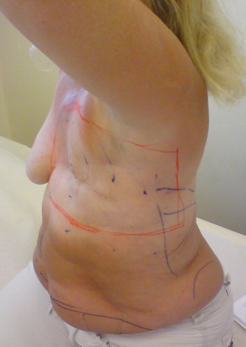 Figure 2. Patient 1, 1 year after surgery.
