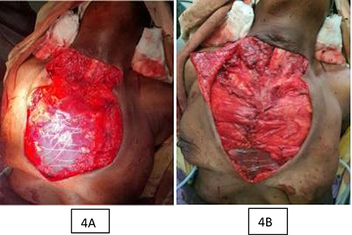 Figure 4 Intraoperative picture showing chest wall reconstruction done by bridging wire, propylene mesh and bilateral pectoralis major advancement flap. (A) Propylene mesh fixed over a bridging sternal wire connecting opposite side rib 3 to 6 (B): Bilateral pectoralis major advancement flap over the mesh.