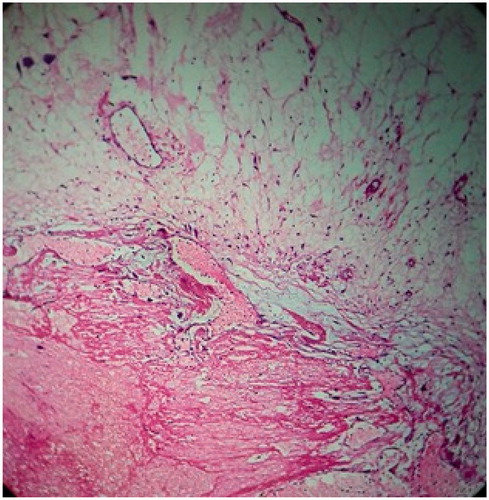Figure 7. Histopathology showing atypical spindle cells and ectatic blood vessels in eosinophilic stroma.