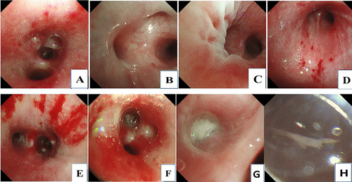 Figure 7 Mucosal changes under fiberoptic bronchoscopy. (A) 7-year-old girl with mucosal congestion and bleeding; (B) 4-year-old boy with pale mucosa; (C) 3-year-old girl with mucosal folds; (D) 11-year-old girl with mucosal bleeding points and folds; (E) 9-year-old boy with mucosal hemorrhage; (F) 5-year-old Mucous membrane erosion in a girl; (G) Sputum suppository in a 5-year-old boy; (H) Bronchial tube shape in a 4-year-old boy.