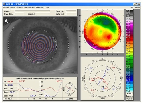 Figure 3 (A) Right eye videokeratographic map in a 34-year-old female patient before treatment. The topographic pattern highlights irregular astigmatism (relative scale, tangential algorithm). (B) Pattern of transepithelial customized ablation. (C) Right eye videokeratographic map 2 years after customized photorefractive keratectomy and corneal collagen cross-linking with riboflavin and ultraviolet A irradiation. The topographic pattern showed an improvement in the corneal profile, with central flattening (relative scale, tangential algorithm).