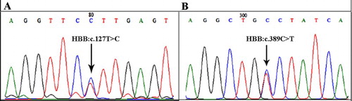 Figure 2. DNA sequencing chromatogram of proband’s β-globin gene. (A) Heterozygous Hb Louisville [β42(CD1)Phe→Leu] as shown by presence of both T and C at codon 42. (B) Heterozygous Hb La Desirade [β129(H7)Ala→Val] as shown by presence of both C and T at codon 129.