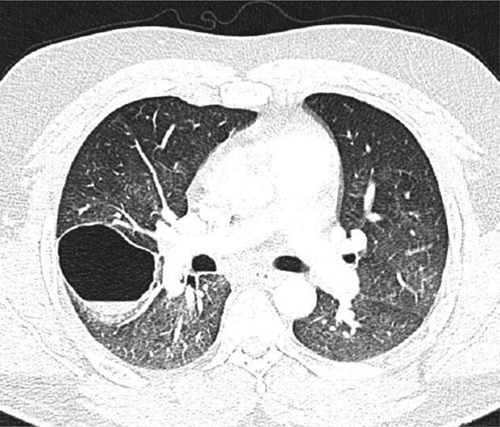 Figure 2. CT Chest: Right lower lobe pneumatocele with air fluid level. Other findings included bilateral ground glass changes.