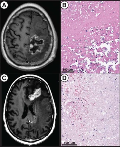 Figure 2. Severe necrosis of two metastases. (A) T1-weighted, post contrast MRI showing prominent size of a dominant left frontoparietal lesion. (B) Postoperative pathology showing necrotic and fibrinous material and, at upper right, dystrophic mineralization without evidence of active tumor (H&E staining). (C) T1-weighted, post contrast MRI showing a dominant, bilobed left frontal lesion with surrounding vasogenic edema responsible for the patient’s symptoms and treated via LITT. (D) Pathology of the targeted lesion showing tissue necrosis with few mononuclear cells (H&E).LITT: Laser-interstitial thermal therapy.