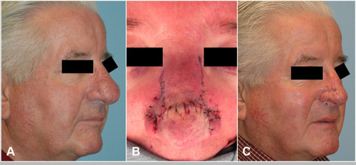 Figure 3 (A) Pre-operative photo of patient with rhinophyma refractory to laser and tangential excision. (B) Intra-operative result after undergoing subunit method. Note incisions are planned at the subunit junctions. (C) Post-operative image with improvement in rhinophyma and nasal definition.
