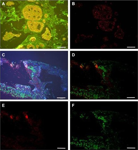 Figure 2 CCL5 and collagen IV detection and quantification in luminal B (HER2−) tissue.Notes: (A) CCL5 fluorescence of orange red QDs with specific distribution in the cytoplasm of cancer cell. (B) Software separation of CCL5 QD fluorescence. (C) CCL5 (red) on the cytoplasm of cancer cell and collagen IV (green) in the ECM were visible at high resolution against the clear discernable background. (D) Software separation of CCL5 and collagen IV QD fluorescence. (E) Spectrally isolated CCL5 single expression signals. (F) Spectrally isolated collagen IV single expression signals. Scale bar=100 μm.Abbreviations: CCL5, chemokine (C–C motif) ligand 5; ECM, extracellular matrix; QD, quantum dot.