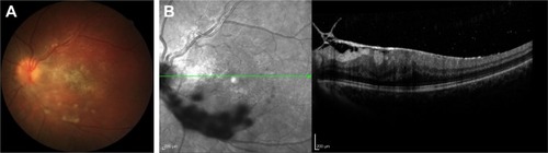 Figure 4 Color photo of an 18-year-old female with pars planitis showing snowball-like vitreous accumulations over the posterior pole (A) and optical coherence tomography demonstrating vitreoretinal traction with macular thickening (B).