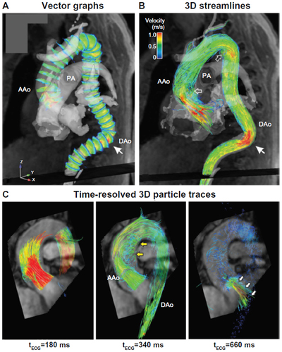 Figure 4 Three-dimensional blood flow visualization in the thoracic aorta.